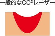 一般的なCO2レーザー